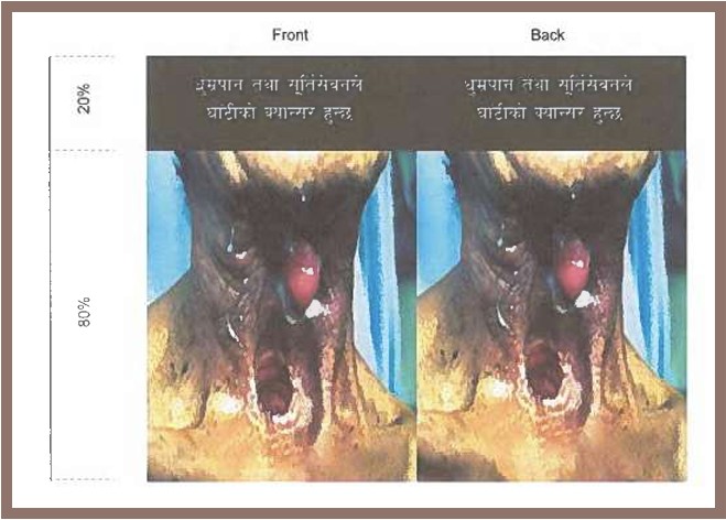 सुर्तीजन्य पदार्थमा शतप्रतिशत चेतावनी चित्र : जनस्वास्थ्य र व्यापारबीचको टकराव